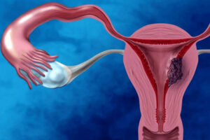 Лечение рака матки в Израиле