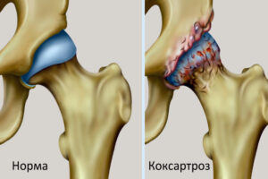 Лечение коксартроза тазобедренного сустава