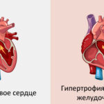 Гипертрофия миокарда