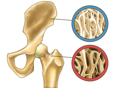 Сочетание остеопороза и остеохондроза