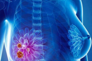 Лечение рака груди в Израиле