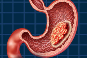 Лечение рака желудка в Израиле