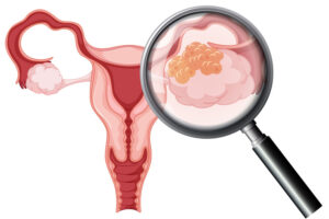 Лечение рака яичника в Израиле