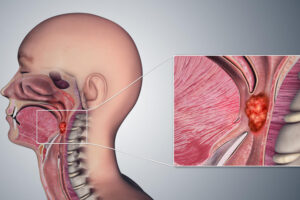 Лечение рака гортани в Израиле
