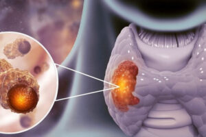 Лечение рака щитовидной железы в Израиле