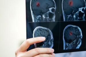 Лечение менингиомы в Израиле