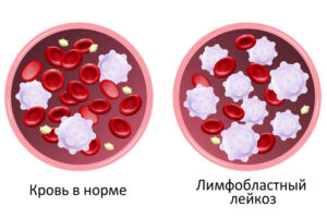 Лечение острого лимфобластного лейкоза