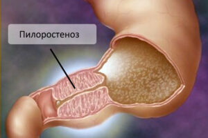 Лечение пилоростеноза в Израиле