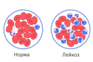 Лечение острого лейкоза в Израиле
