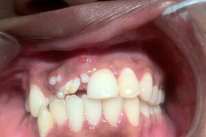 Лечение одонтомы в Израиле