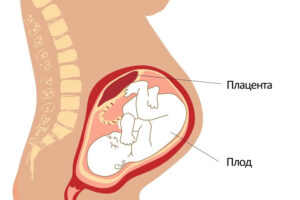 Лечение хориоангиомы плаценты в Израиле