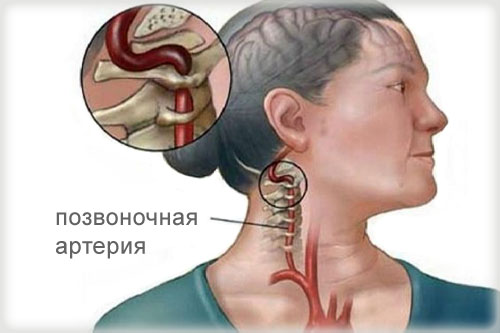 Лечение вертебрально-базилярной недостаточности в Израиле