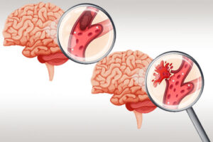 внутримозговые опухоли полушарий мозга