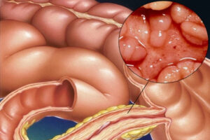 лечение энтерита в Израиле