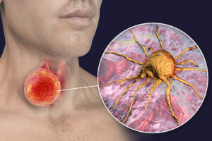 Лечение плоскоклеточного рака гортани в Израиле