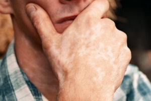 Лечение гемохроматоза в Израиле