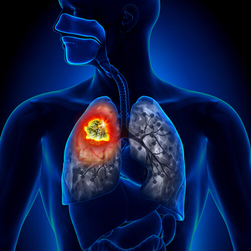 Новое в диагностике рака легких