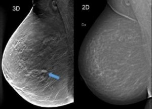3D-маммография груди