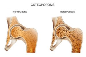 Остеопороз можно обратить вспять – ученые 