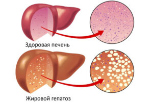 Лечение жирового гепатоза печени в Израиле