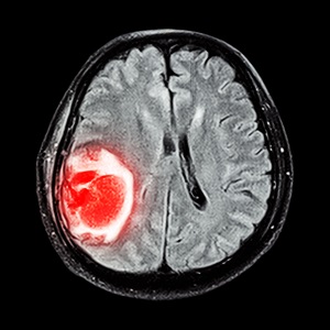 Удаление опухолей мозга увеличивает выживаемость