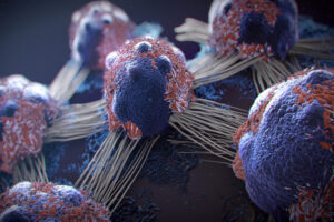 Лечение карциномы из клеток Меркеля в Израиле