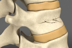 Лечение усталостного перелома позвонка в Израиле
